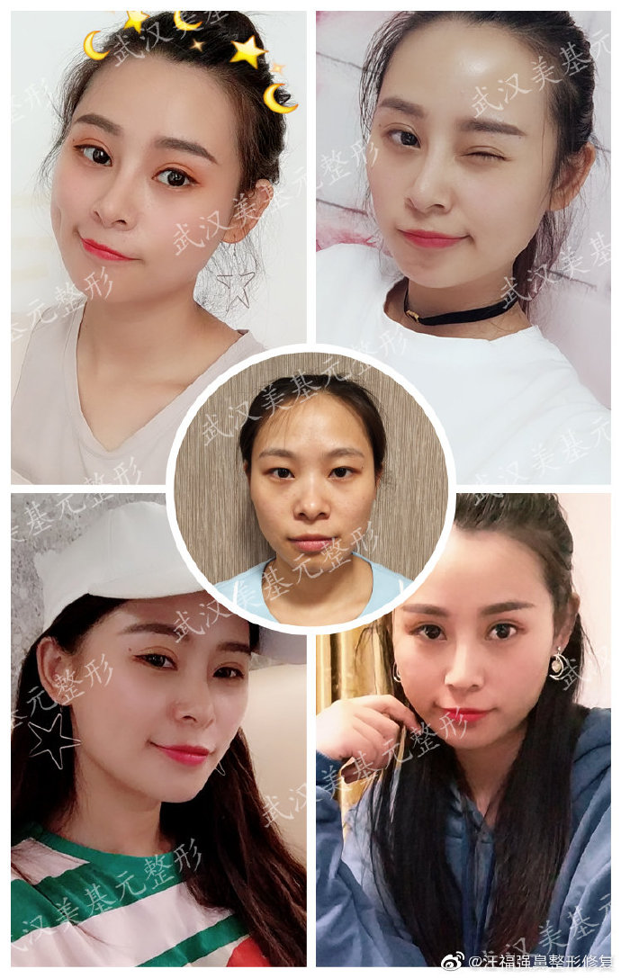 汪福強鼻修復案例