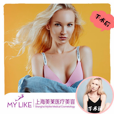 假體豐胸案例