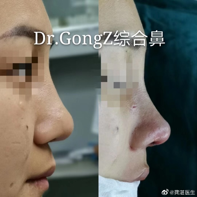 龔湛鼻綜合案例