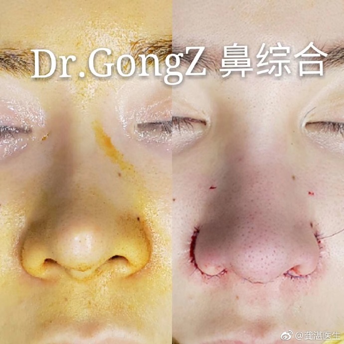 龔湛鼻修復(fù)案例