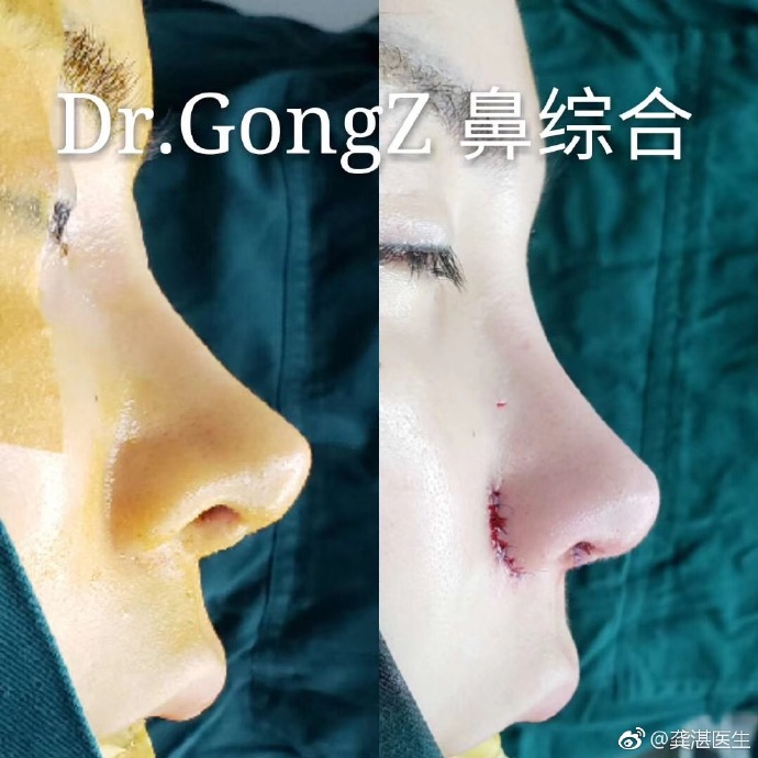 龔湛鼻修復(fù)案例