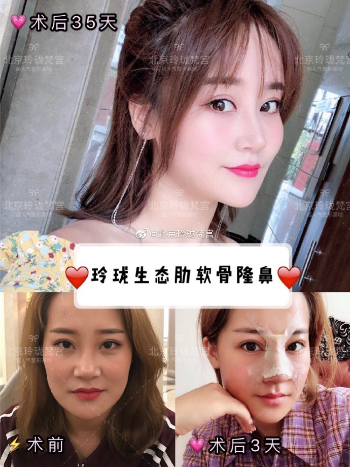 王光輝鼻子案例