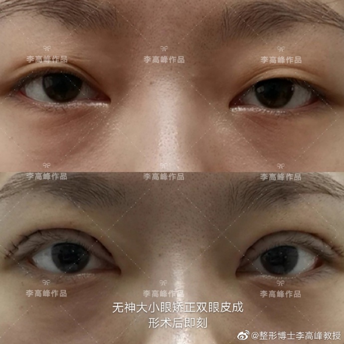 李高峰雙眼皮案例
