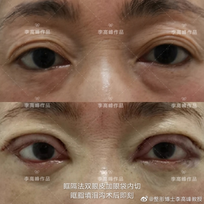 李高峰雙眼皮案例