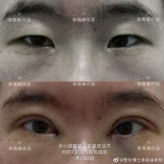 李高峰雙眼皮案例