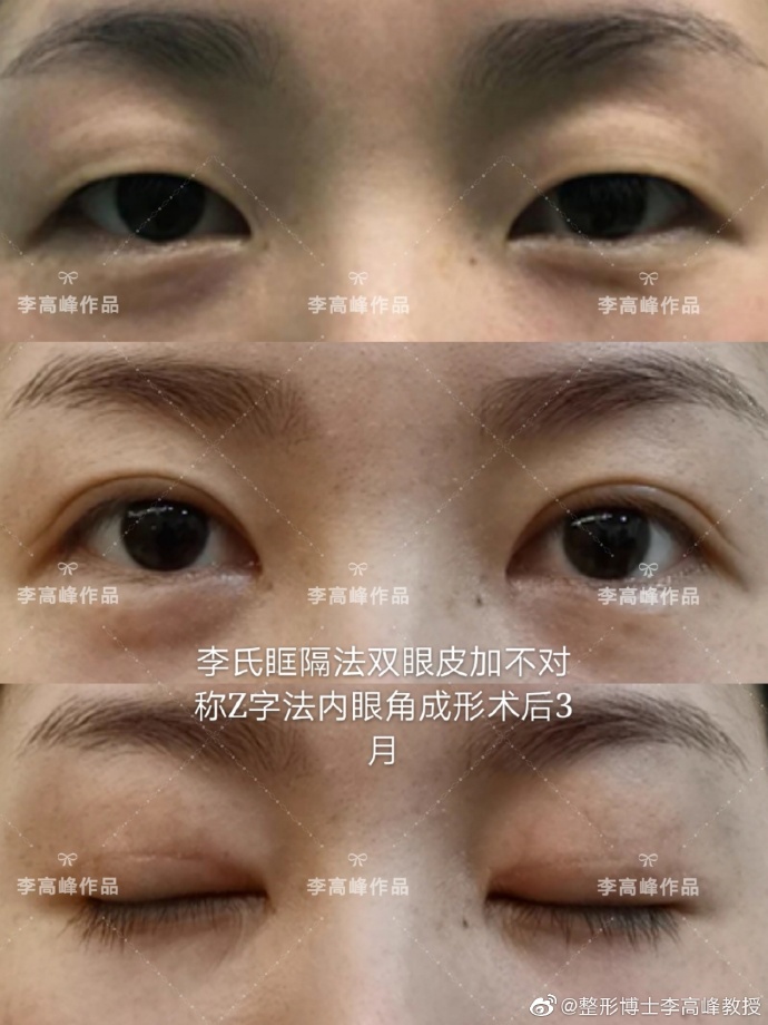 李高峰雙眼皮案例