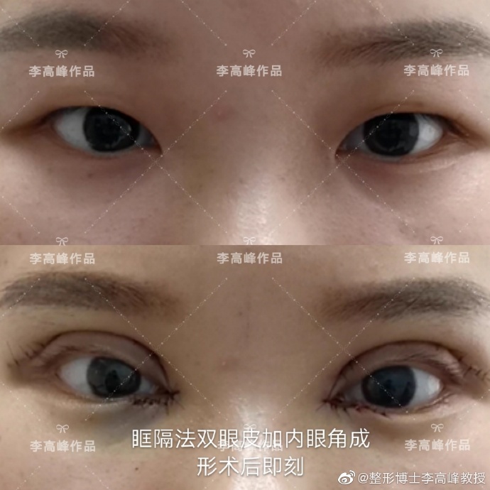 李高峰雙眼皮案例