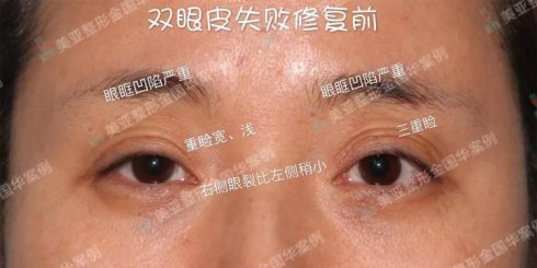 金國華雙眼皮修復案例