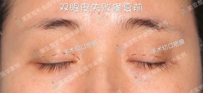 金國華雙眼皮修復案例