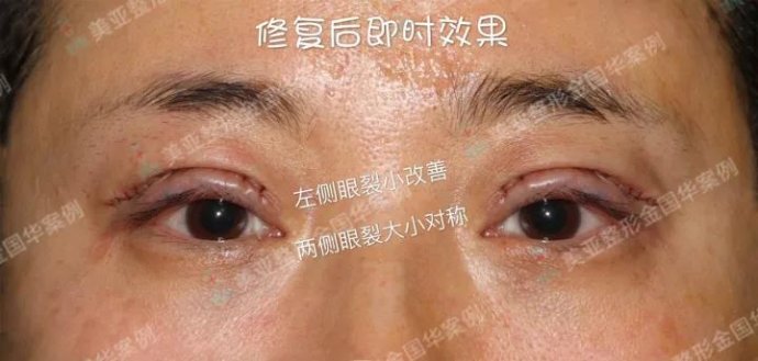 金國華雙眼皮修復案例