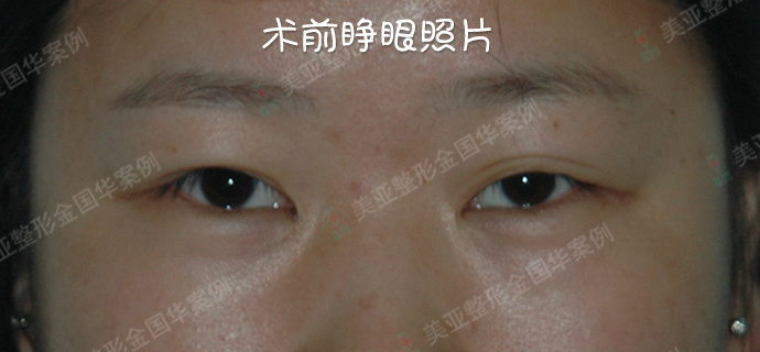 金國華雙眼皮修復案例