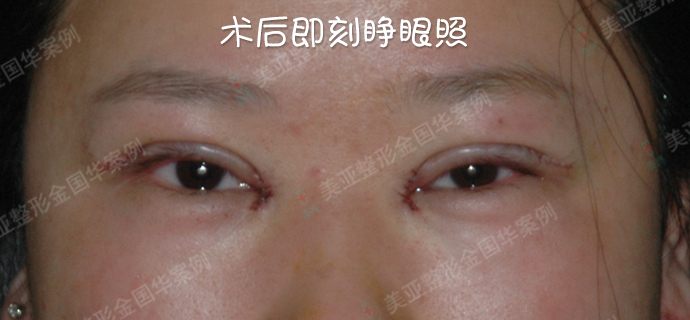 金國華雙眼皮修復案例