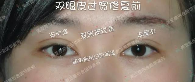 金國華雙眼皮修復案例
