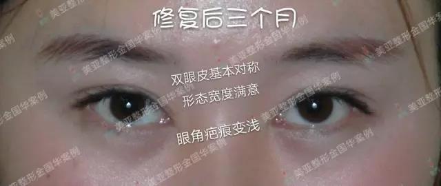 金國華雙眼皮修復案例