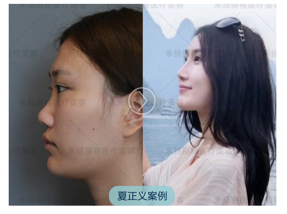 夏正義隆鼻案例