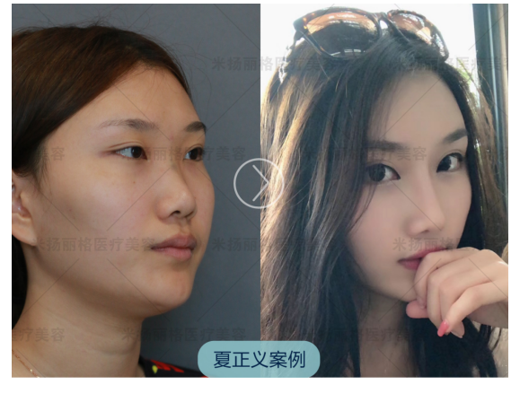 夏正義隆鼻案例