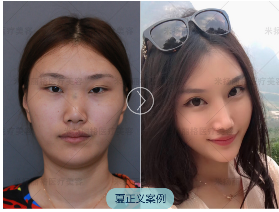 夏正義隆鼻案例