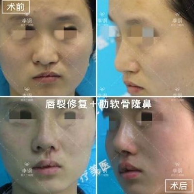 李鋼鼻修復案例