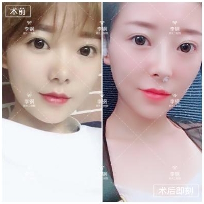 李鋼鼻綜合案例