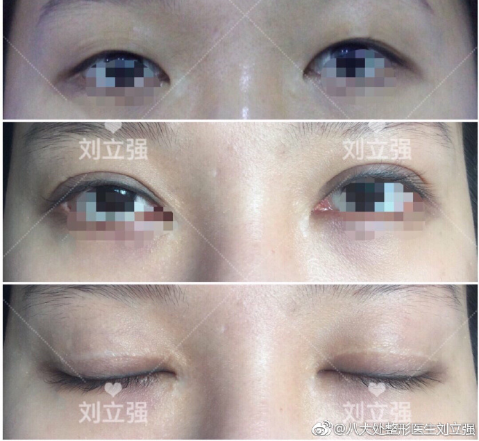 劉立強雙眼皮案例
