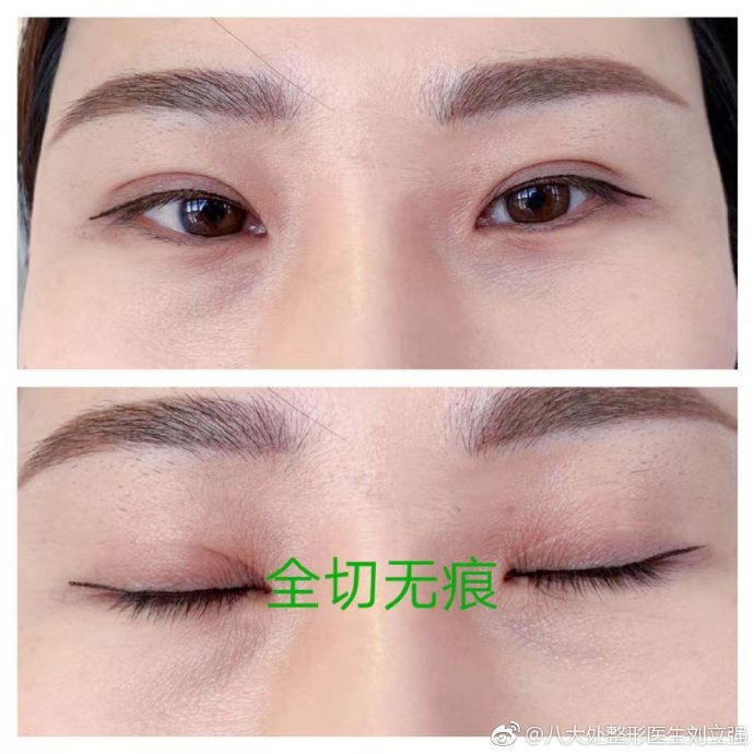 劉立強雙眼皮案例