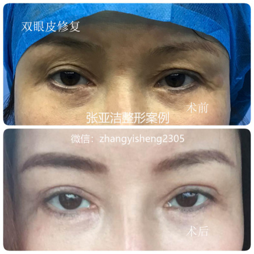 張亞潔雙眼皮修復案例