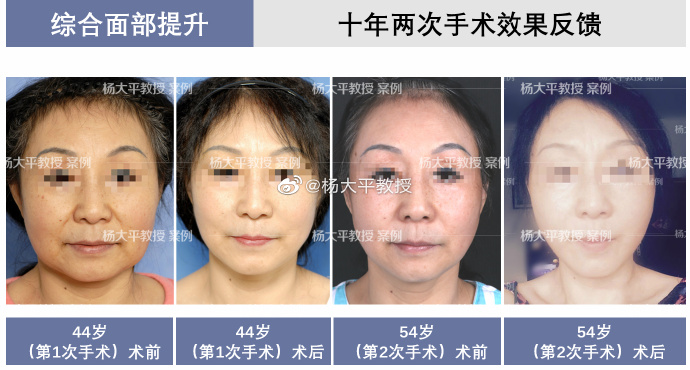 楊大平面部提升案例