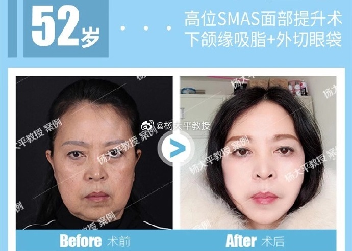 楊大平面部提升案例