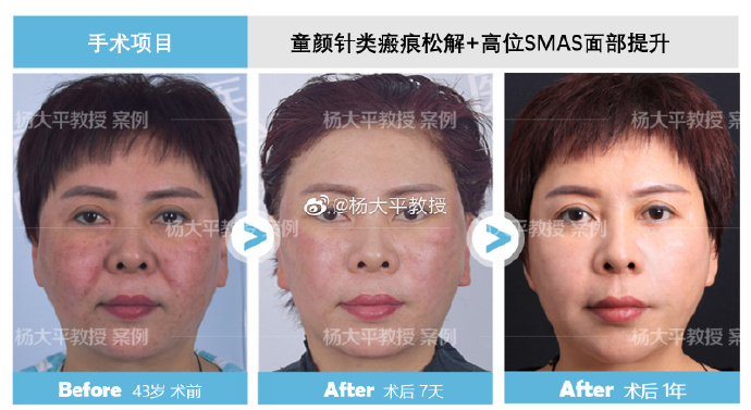 楊大平面部提升案例