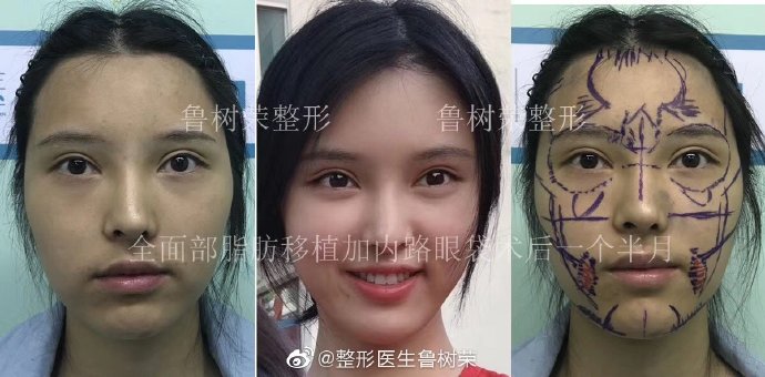 魯樹榮面部填充案例
