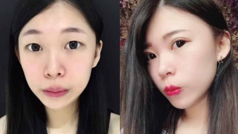雙眼皮案例