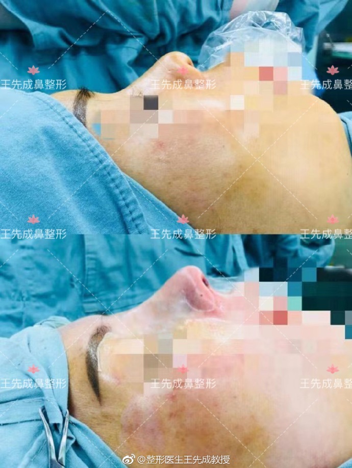 王先成鼻綜合