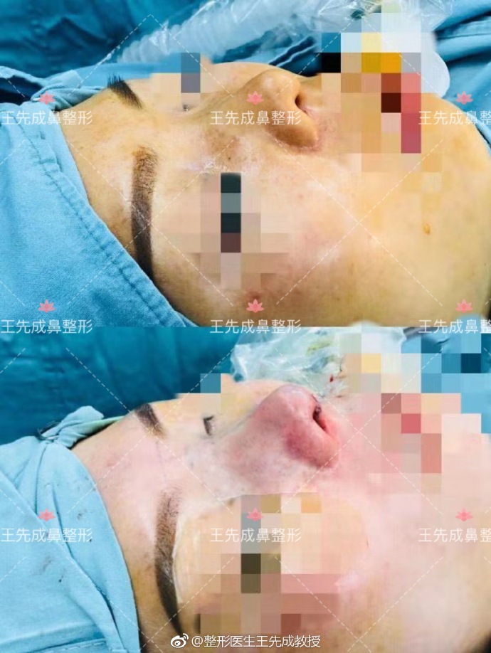 王先成鼻綜合案例