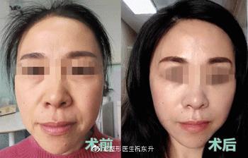 祝東升面部提升案例