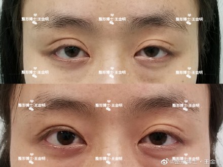 王金明雙眼皮案例