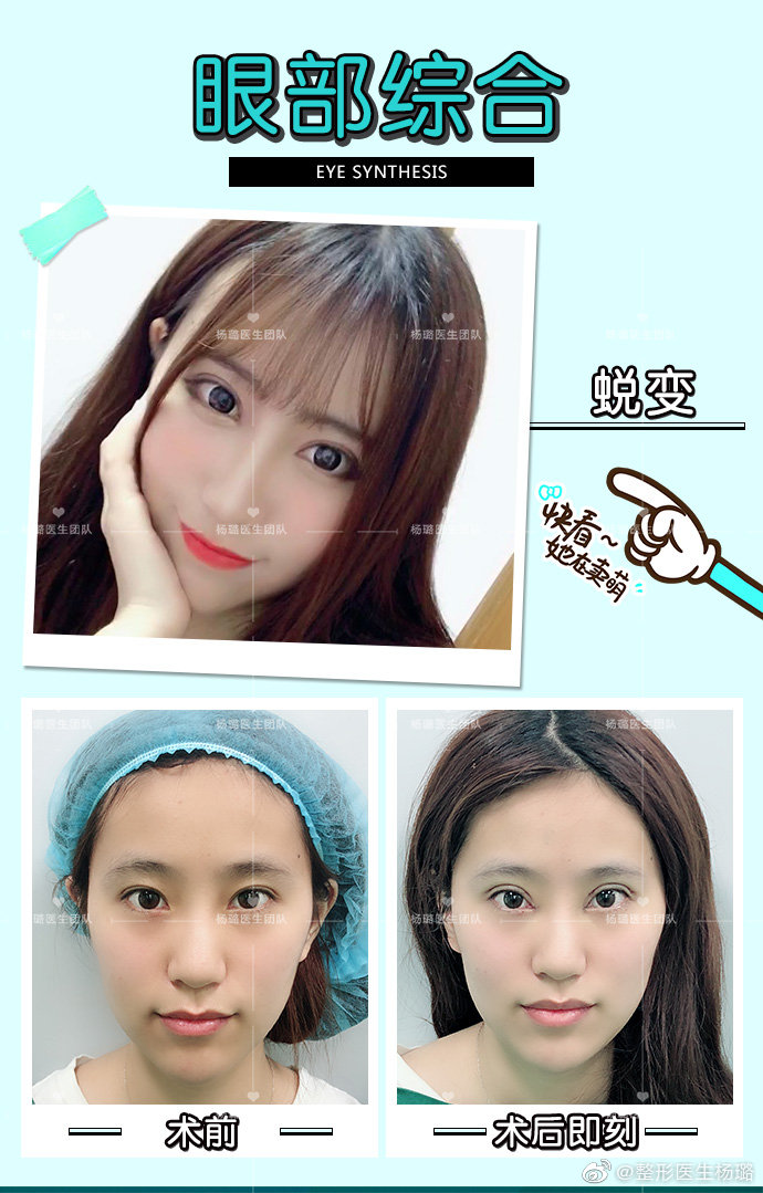 楊璐雙眼皮案例
