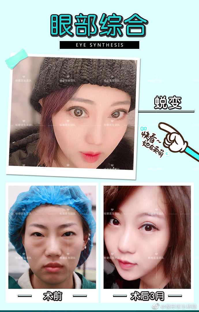 楊璐雙眼皮案例