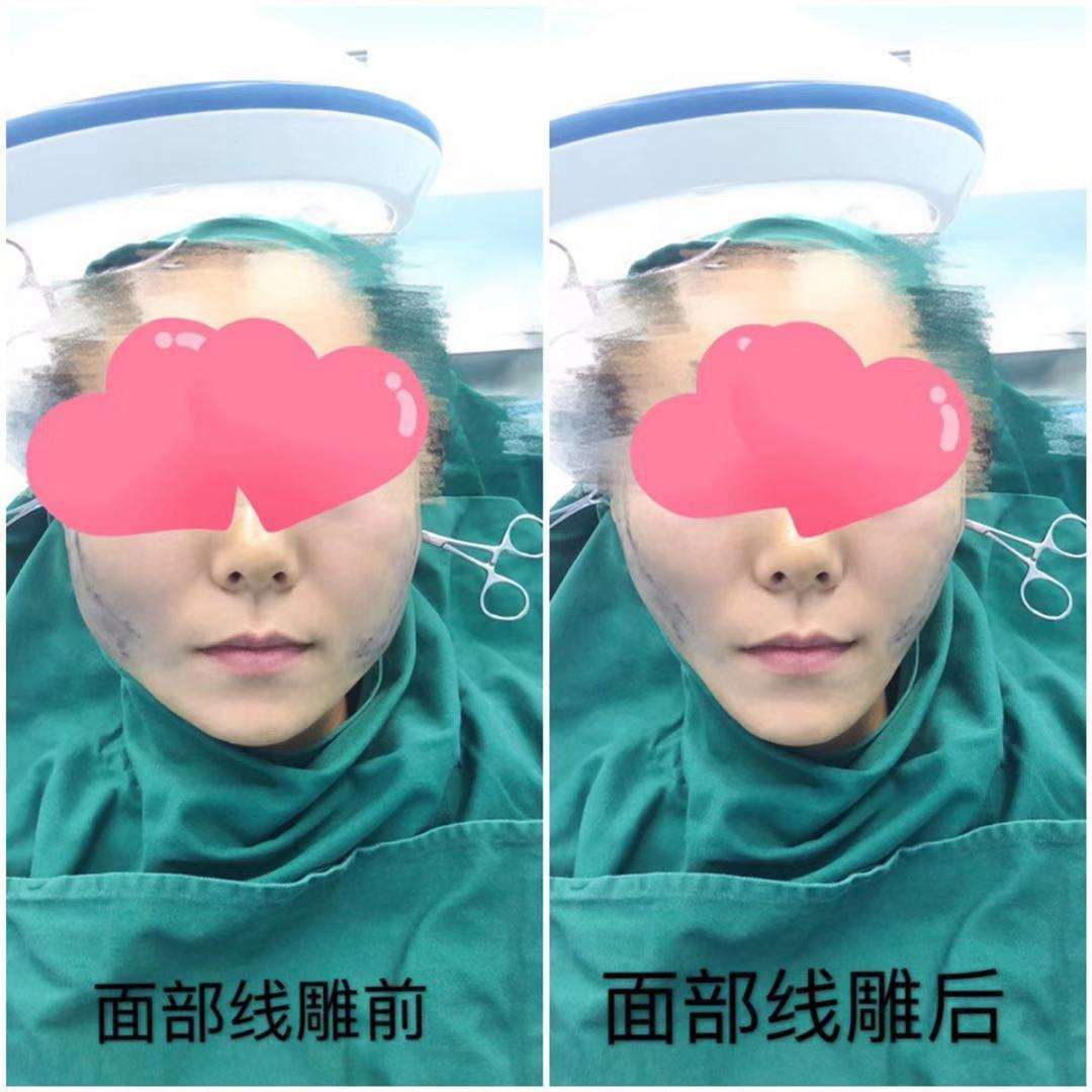 上海九院面部年輕化面部提升除皺專家排名