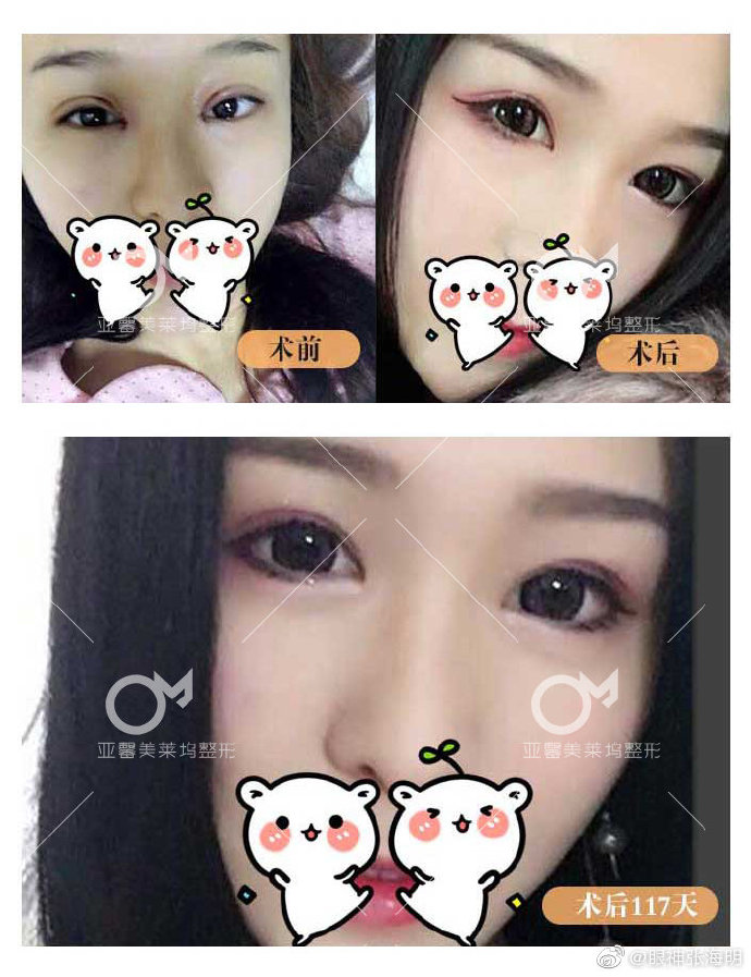 張海明雙眼皮修復(fù)案例