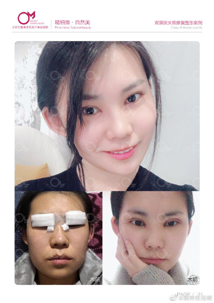 張海明雙眼皮修復(fù)案例