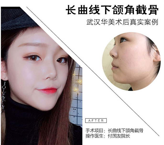 付國友下頜角案例