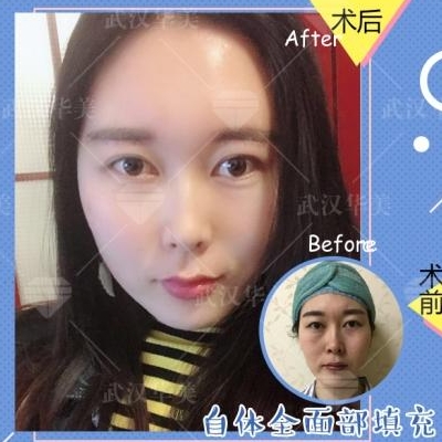 劉光偉面部填充案例