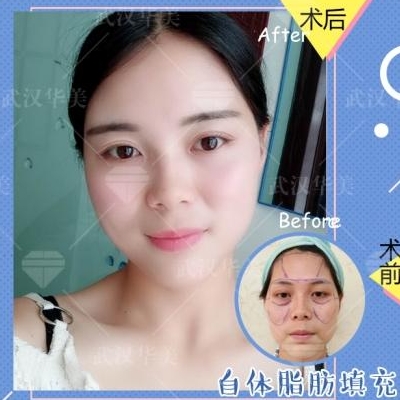 劉光偉面部填充案例