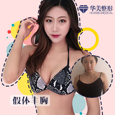 劉光偉假體豐胸案例