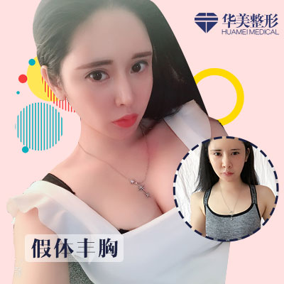 劉光偉假體豐胸案例