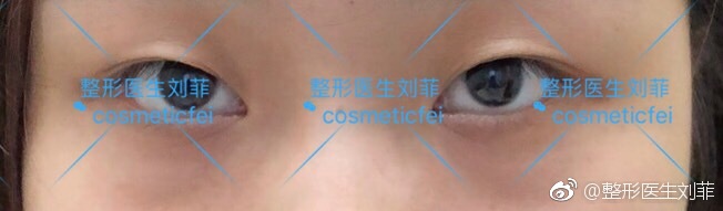 劉菲割雙眼皮案例