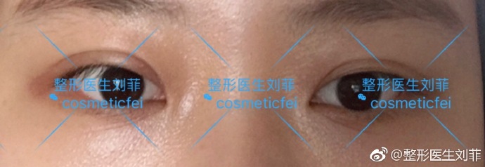 劉菲割雙眼皮案例