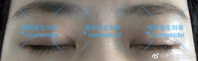 劉菲割雙眼皮案例