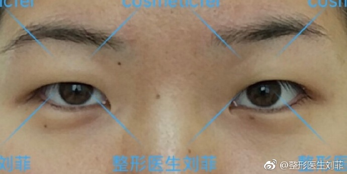 劉菲割雙眼皮案例