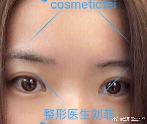 劉菲割雙眼皮案例